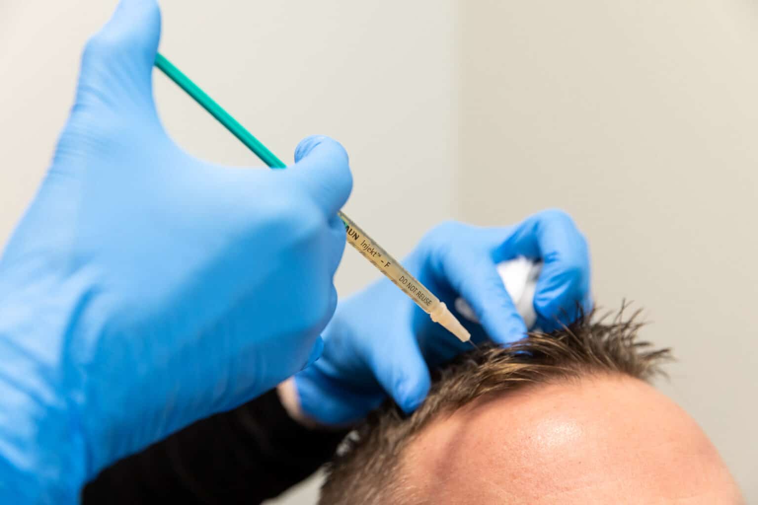 PRP Hair Restoration 1432 1536x1024
