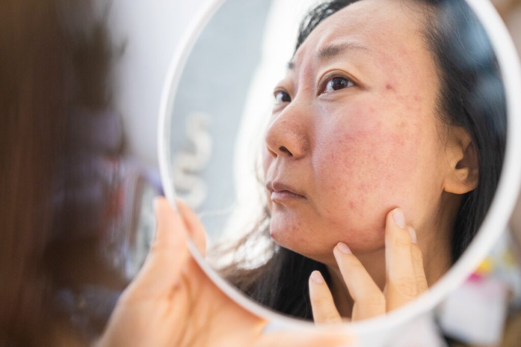 Woman noticing acne scars in a mirror.