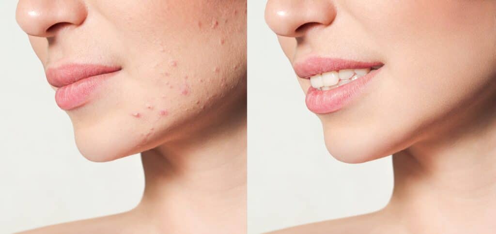 Before and after shot of a woman's jawline after receiving dermal fillers to heal acne scarring
