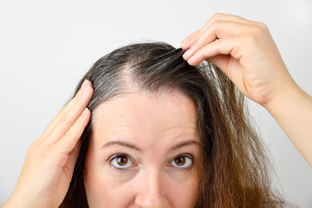 Close up of a woman examining her thinning hair and blading spots, in need of Neograft hair restoration