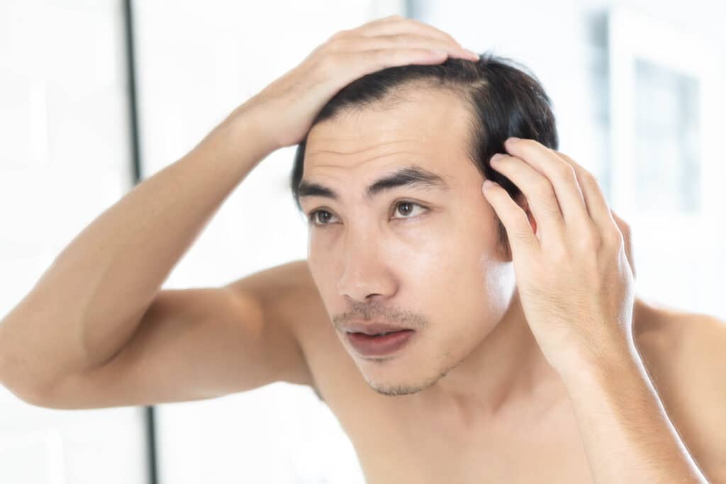 Man looking at a balding spot on his head, in need of NeoGraft hair restoration with PRP