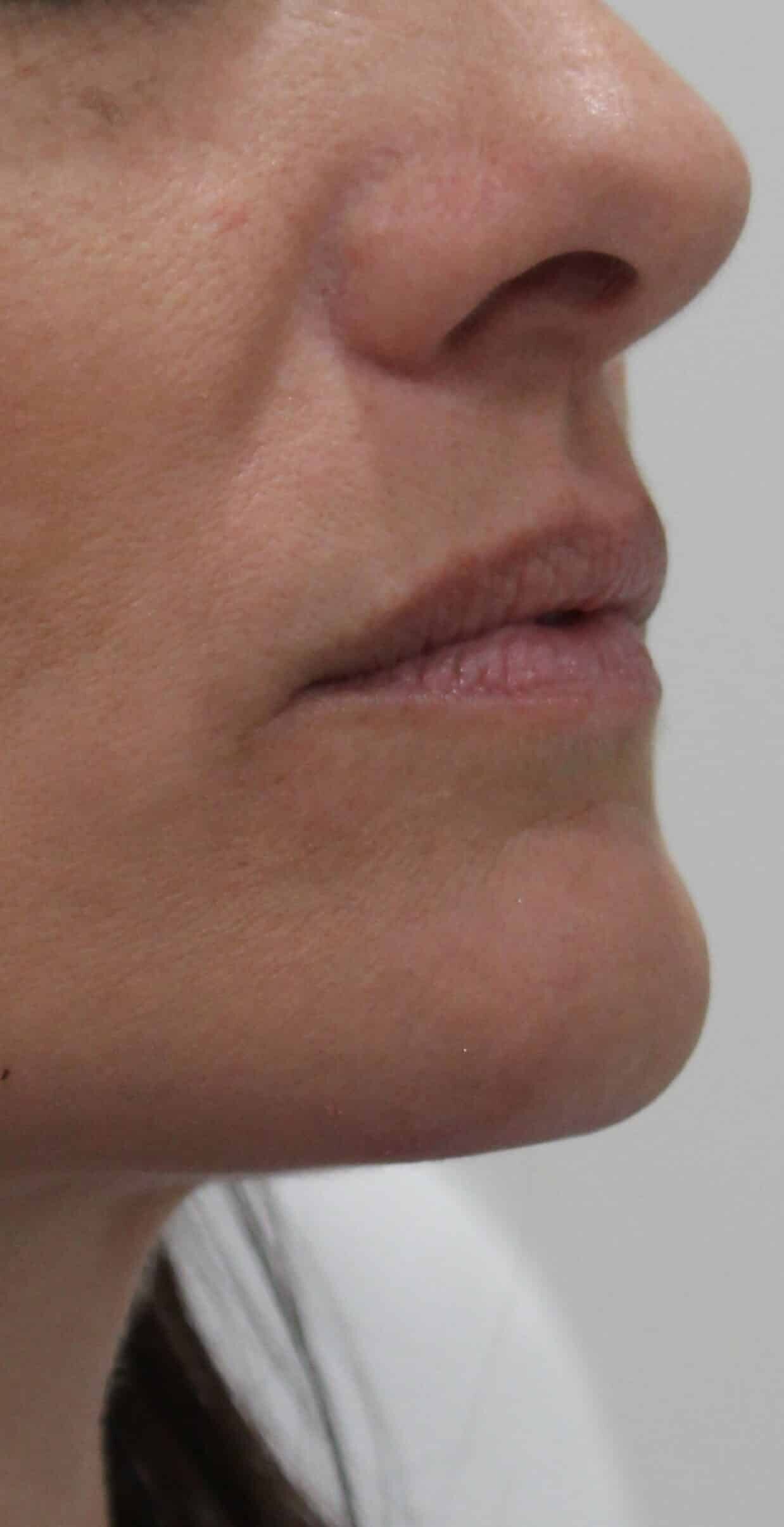 Before Image: Lip Filler - front