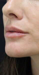 After Image: Lip Filler