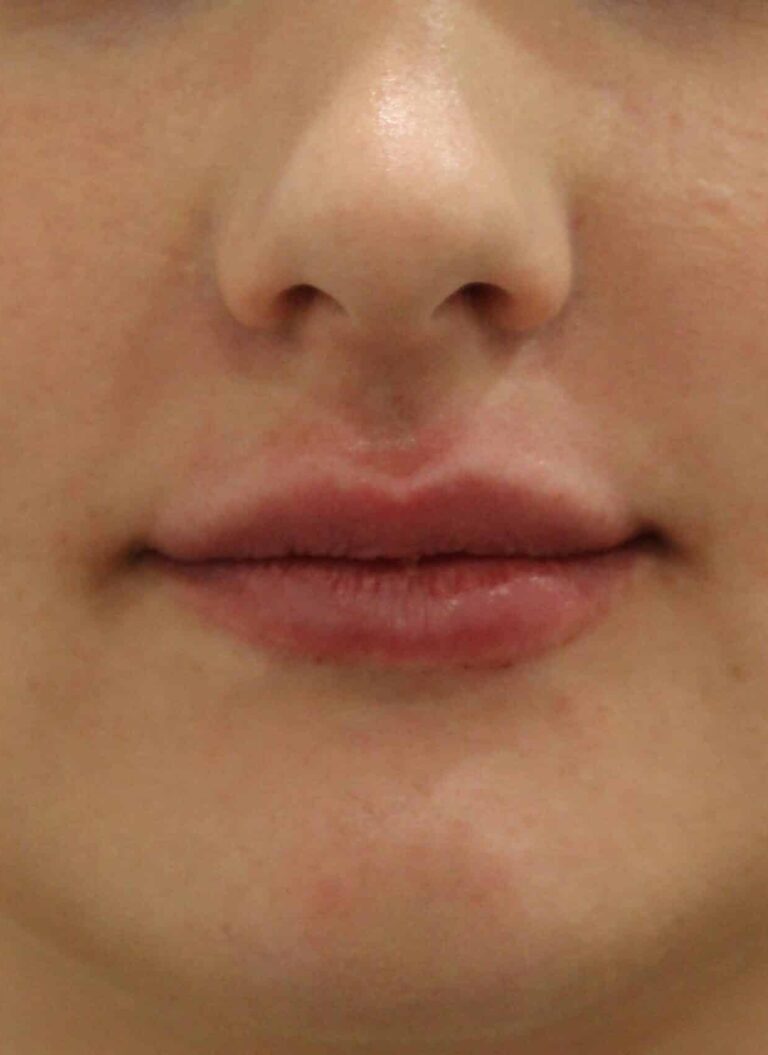 After Image: Lip Filler - front