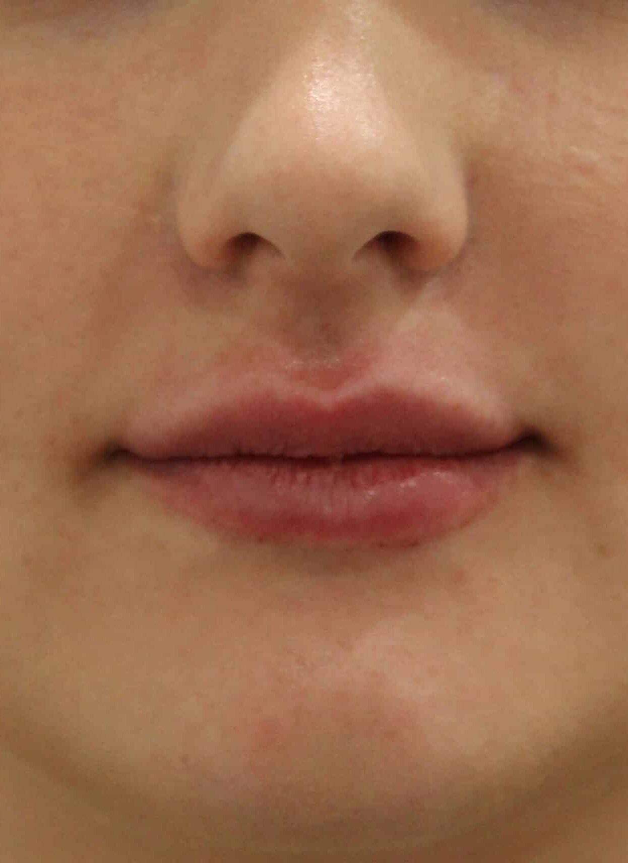 After Image: Lip Filler - front