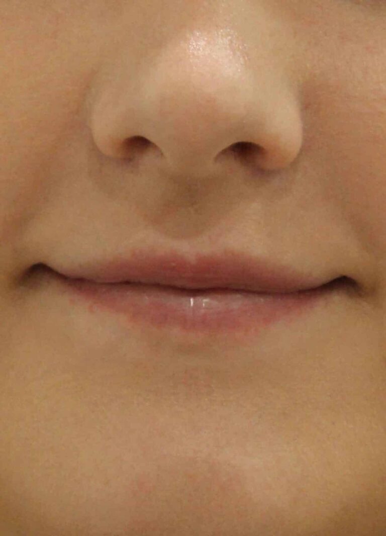 Before Image: Lip Filler - front