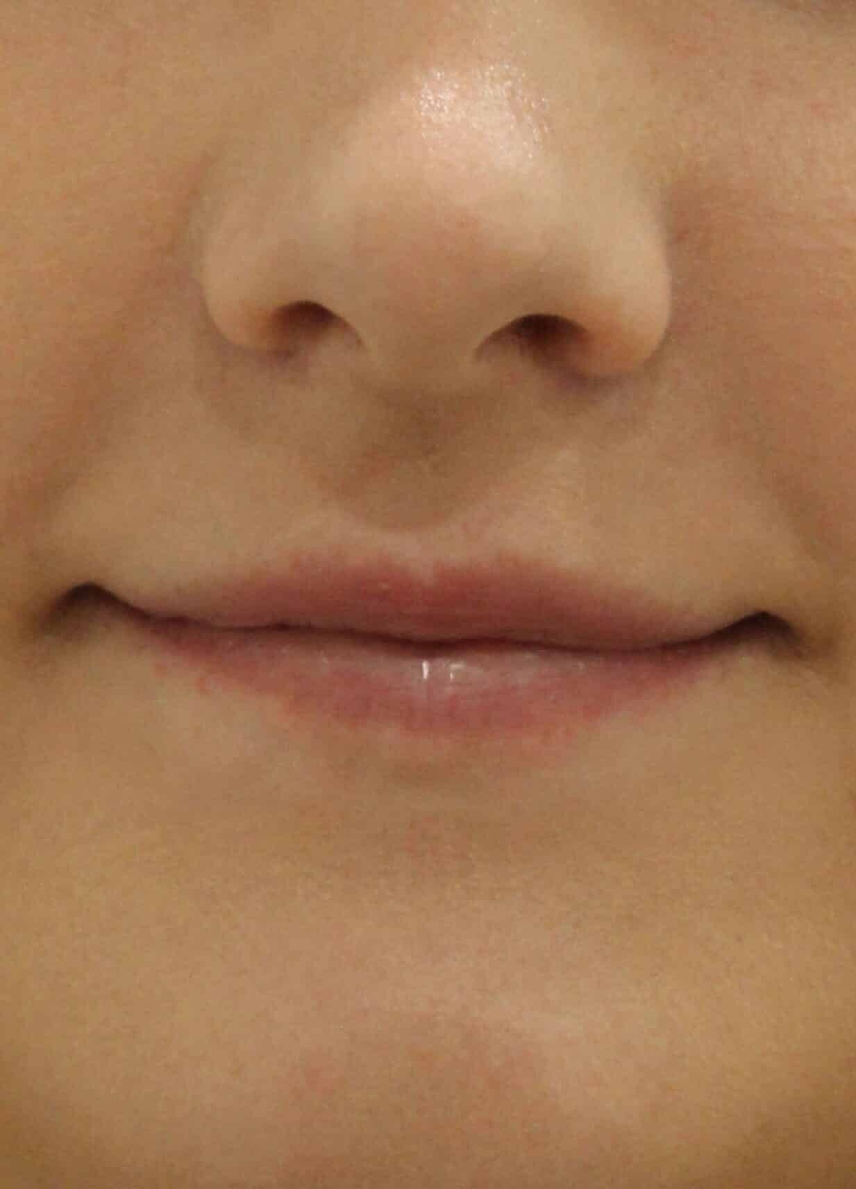 Before Image: Lip Filler - front