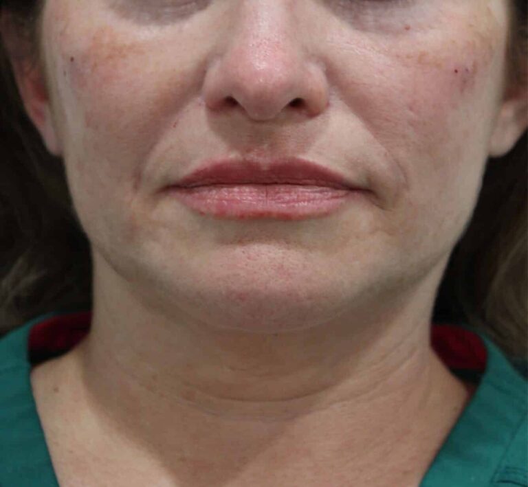 After Image: Lip and Cheek Filler - front