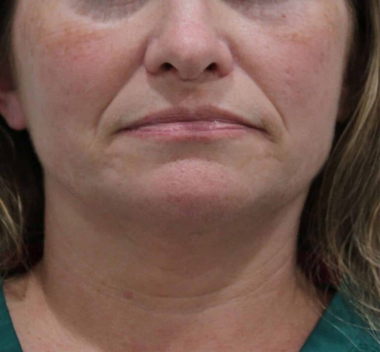 Before Image: Lip and Cheek Filler - front
