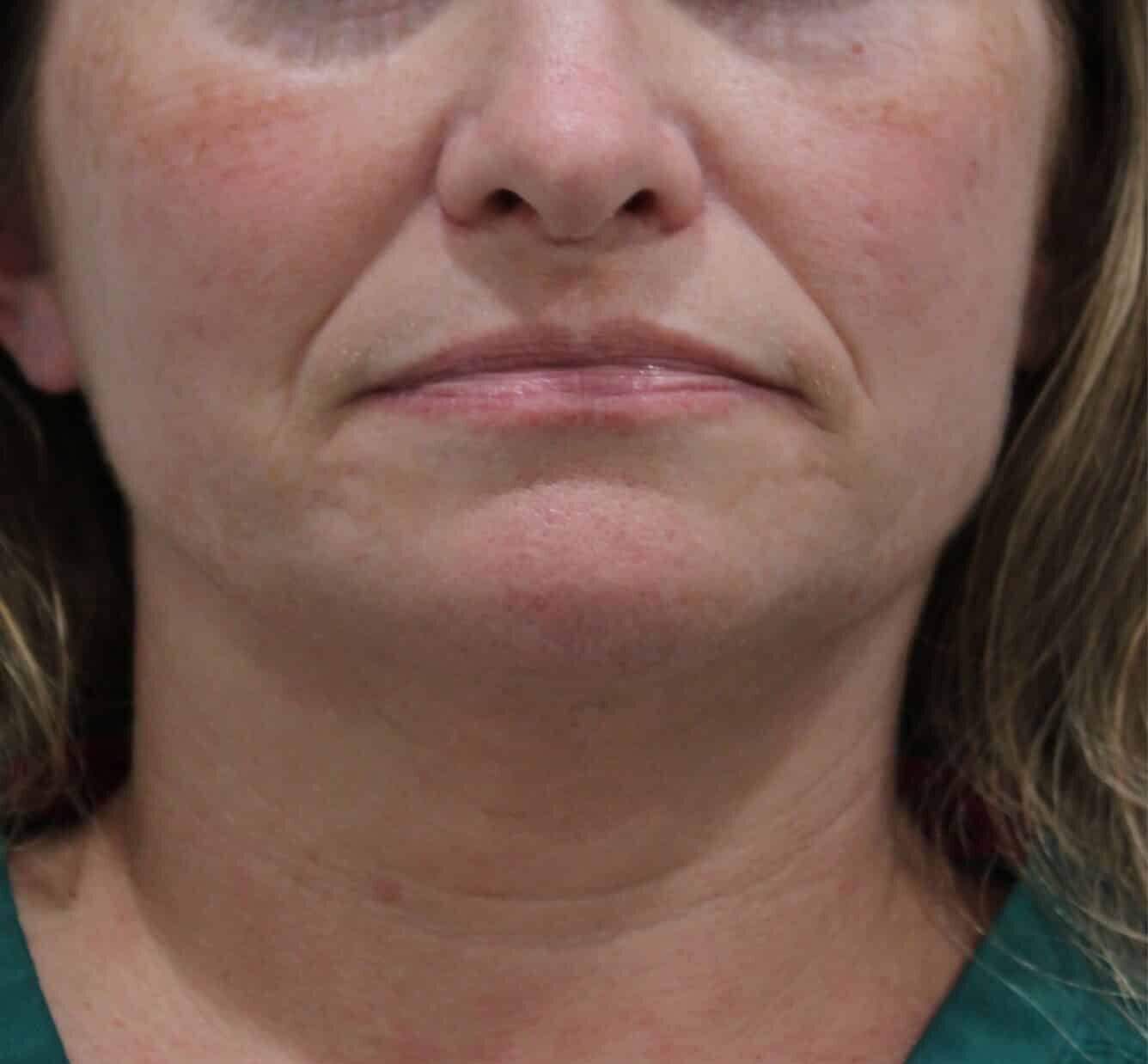 Before Image: Lip and Cheek Filler - front