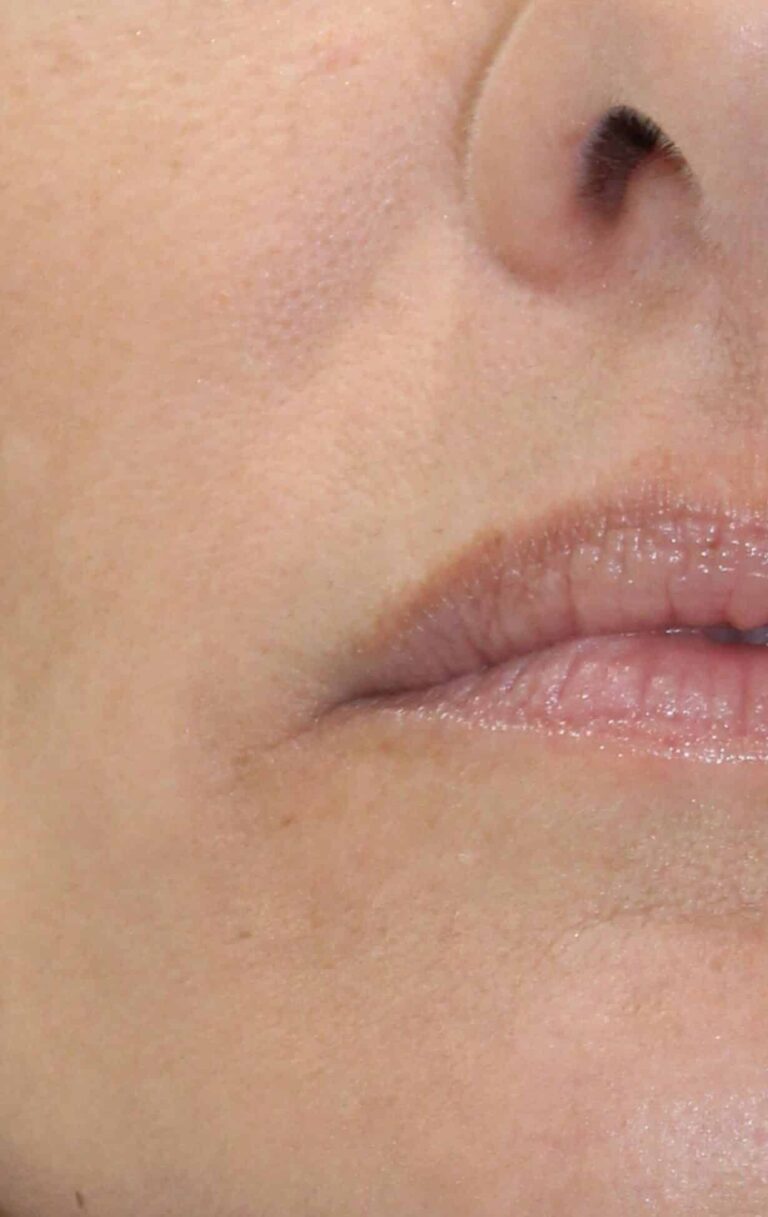 Before Image: Lip Filler - front