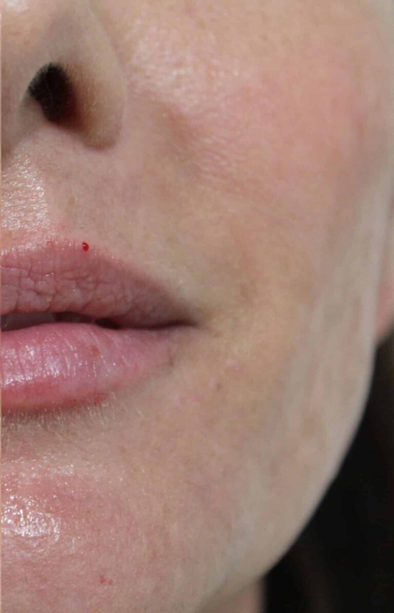 After Image: Lip Filler - front