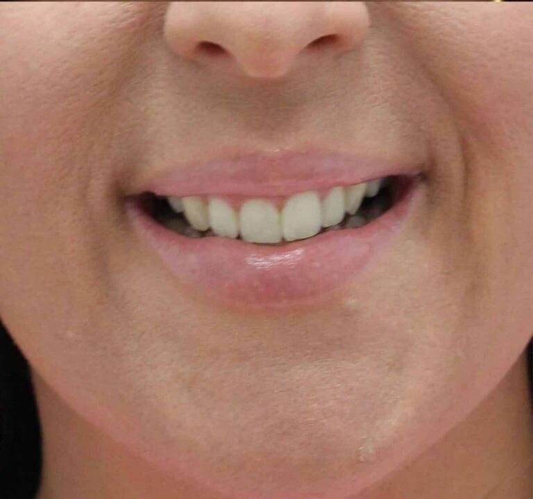 After Image: Lip Filler - front