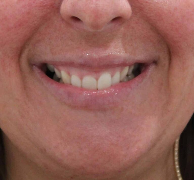 Before Image: Lip Filler - front