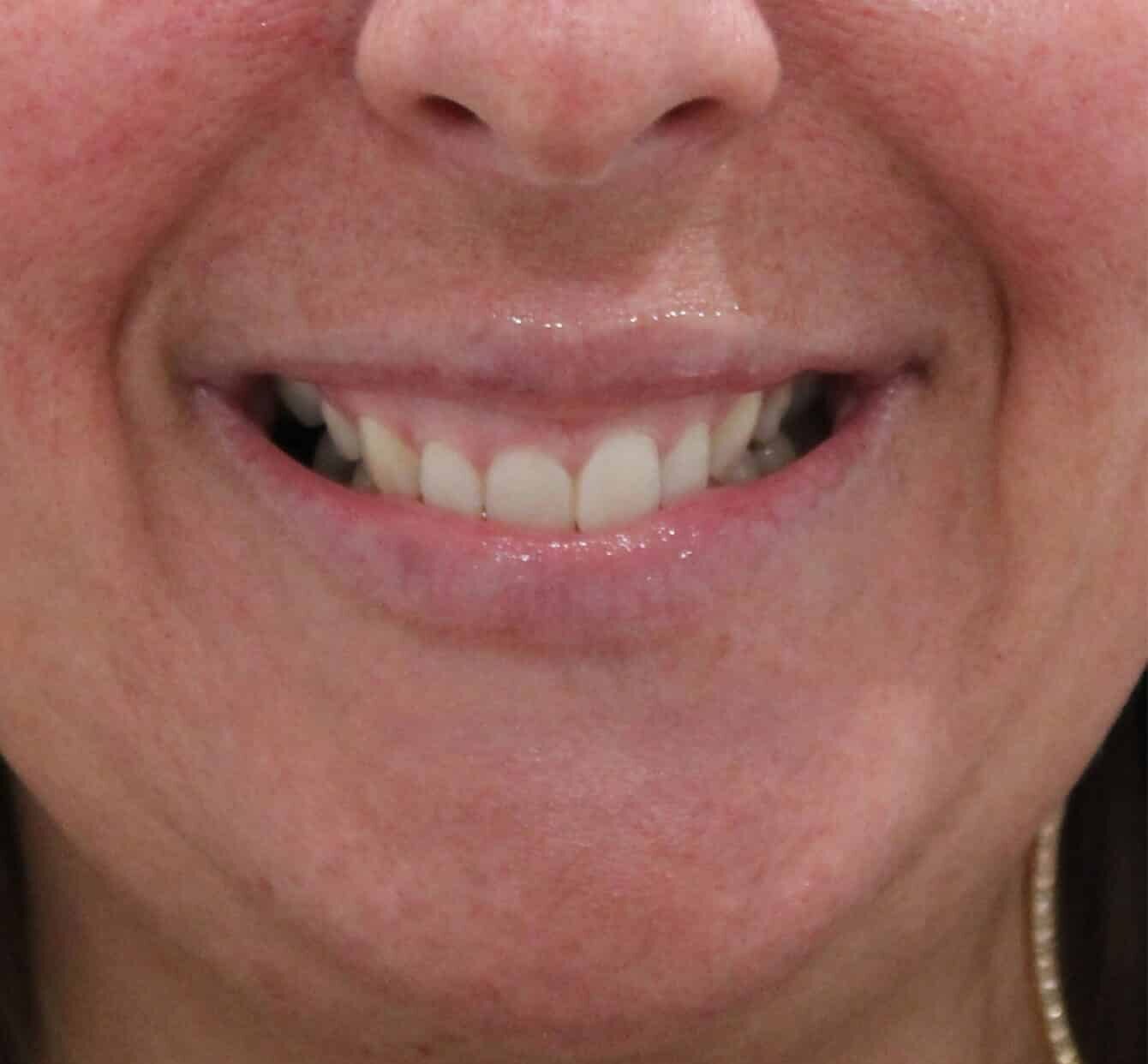 Before Image: Lip Filler - front