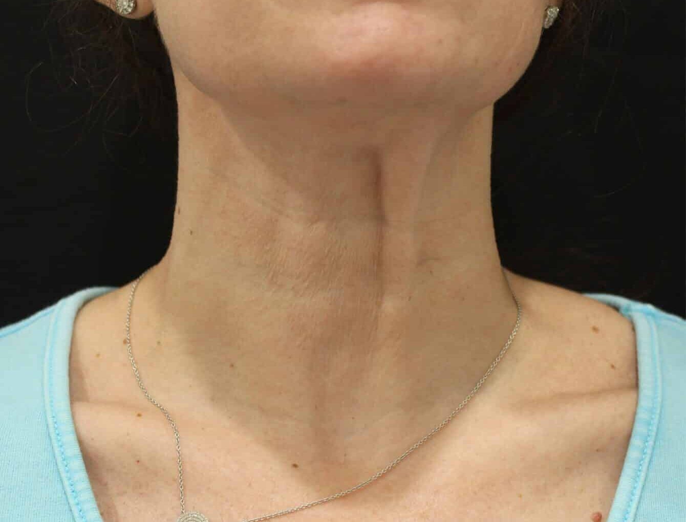 Before Image: Sofwave - front