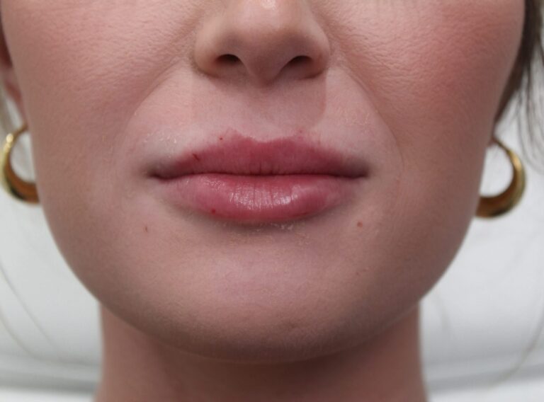 After Image: Lip Filler - front