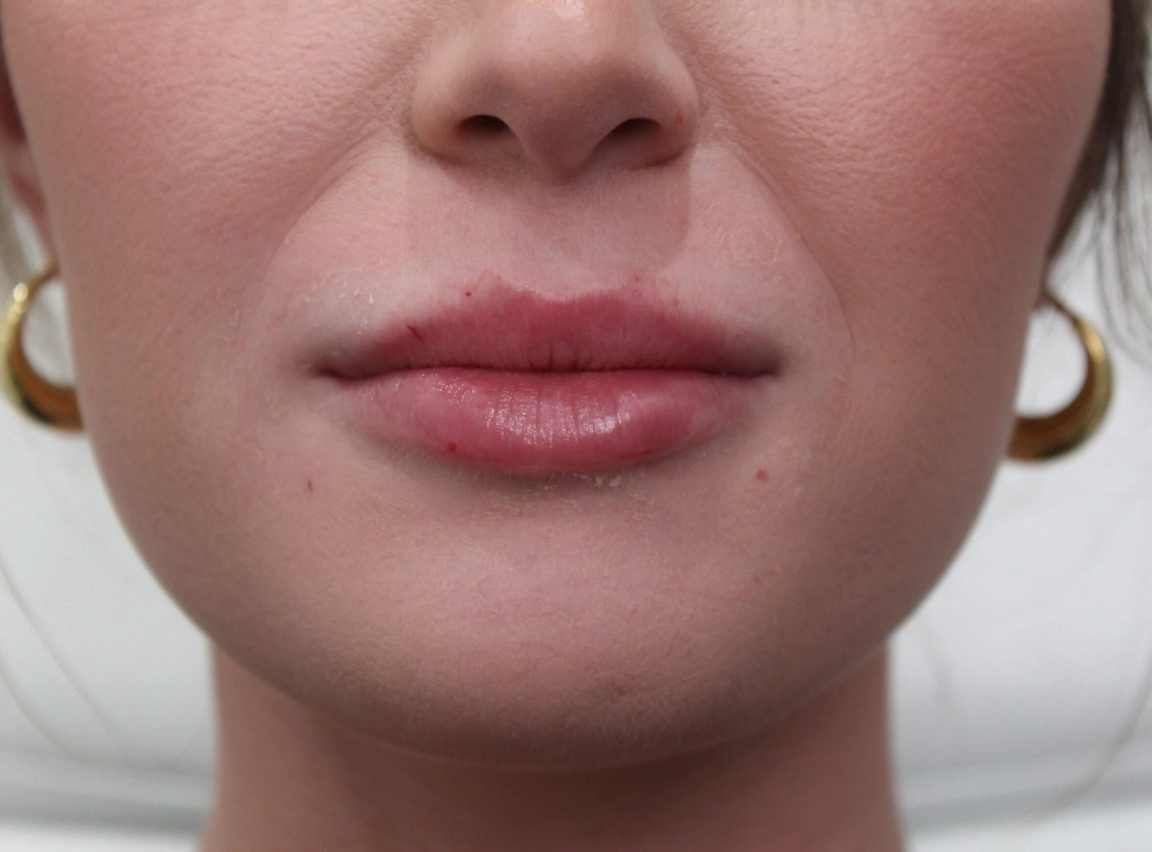 After Image: Lip Filler - front