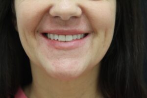 After Image: Lip Filler