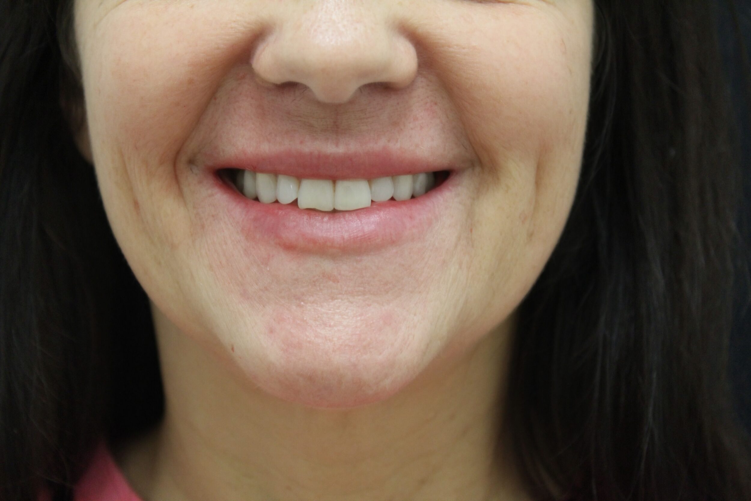 After Image: Lip Filler - front