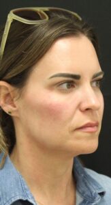 After Image: Cheek Filler