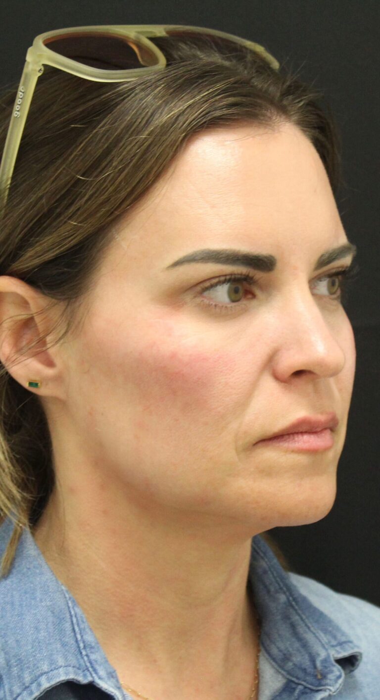 After Image: Cheek Filler - front