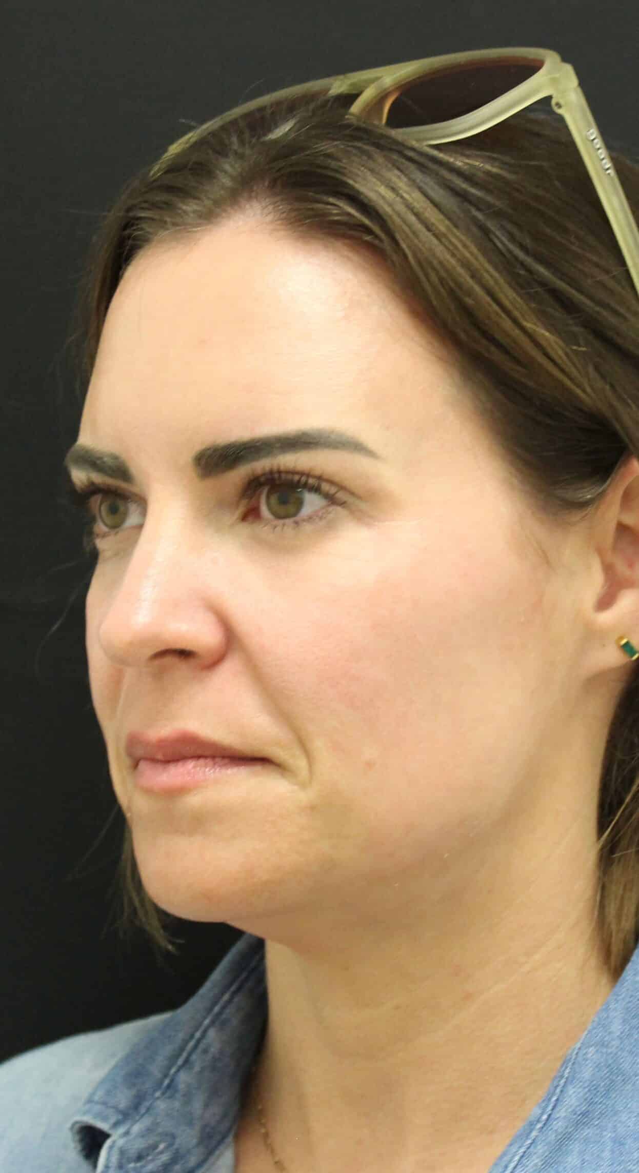 Before Image: Cheek Filler - front