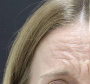Before Image: Neurotoxin