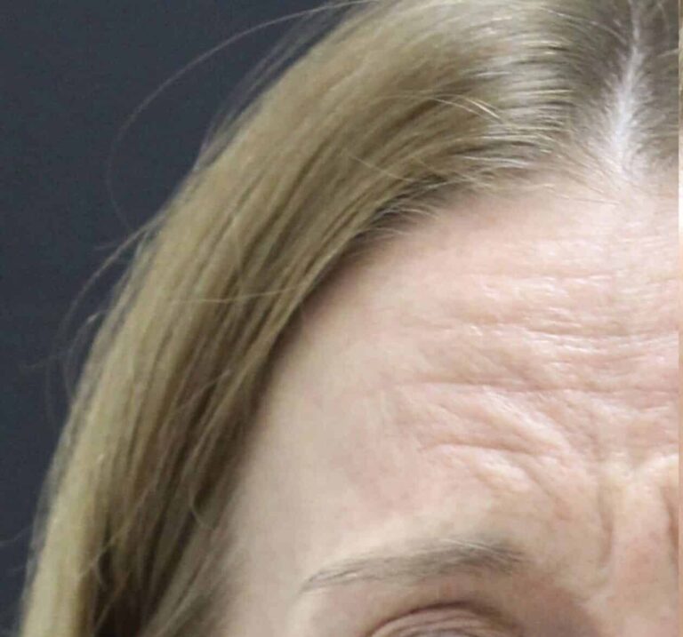 Before Image: Neurotoxin - front