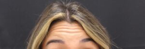 Before Image: Neurotoxin