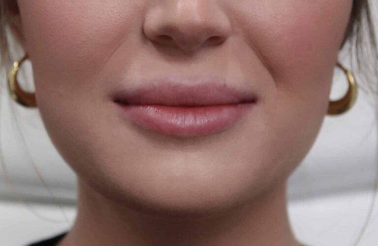 Before Image: Lip Filler - front