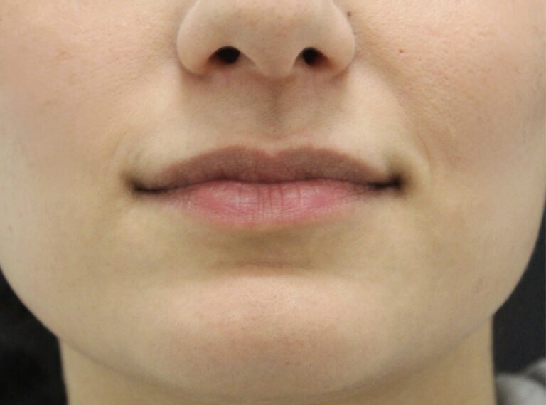 Before Image: Lip Filler - front