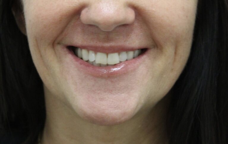 Before Image: Lip Filler - front