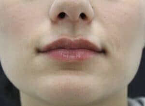 After Image: Lip Filler