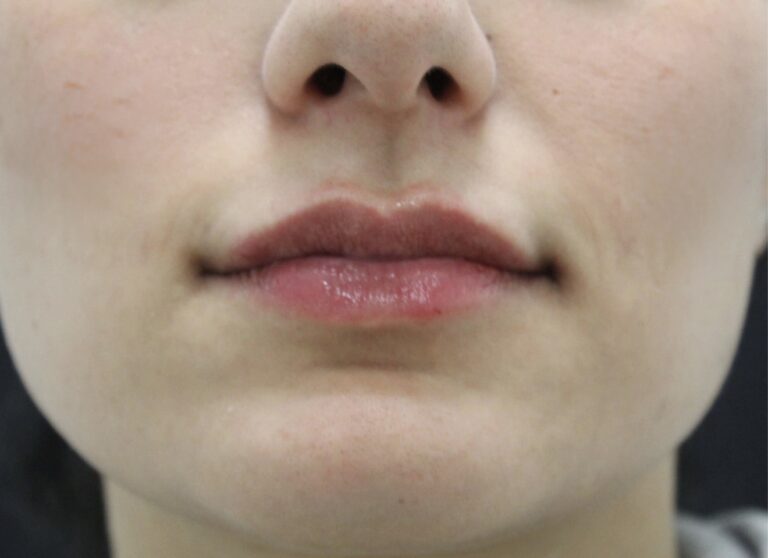 After Image: Lip Filler - front