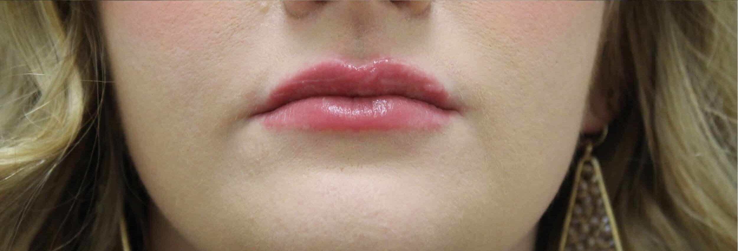 After Image: Lip Filler - front