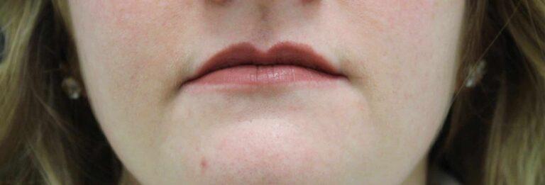 Before Image: Lip Filler - front