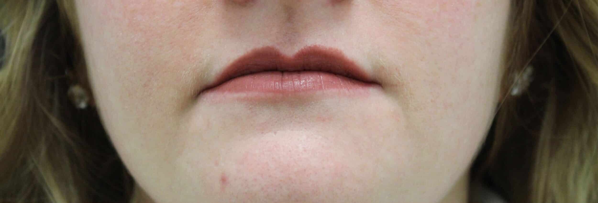 Before Image: Lip Filler - front