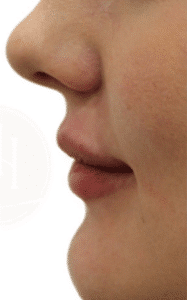 After Image: Lip Filler