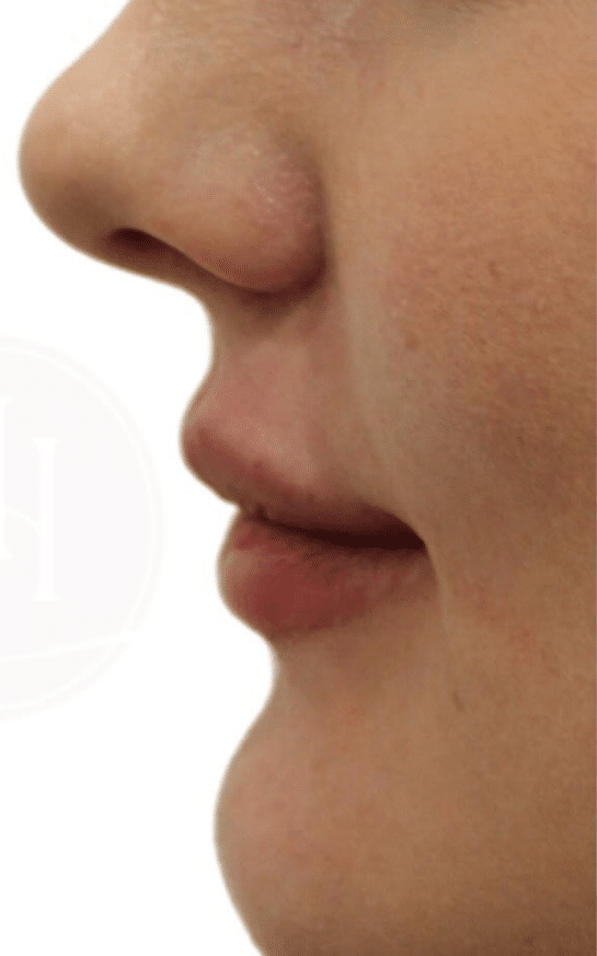 After Image: Lip Filler - front