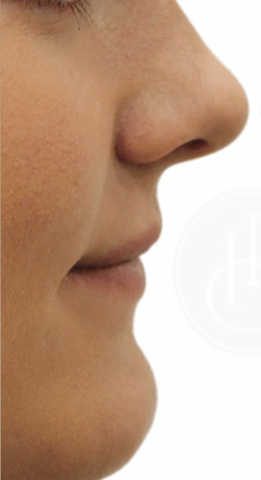 Before Image: Lip Filler - front