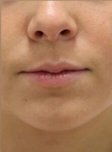Before Image: Lip Filler