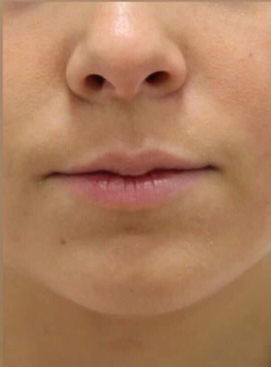 Before Image: Lip Filler - front