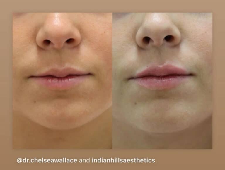 After Image: Lip Filler - front