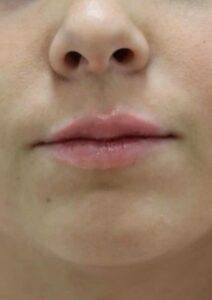 After Image: Lip Filler