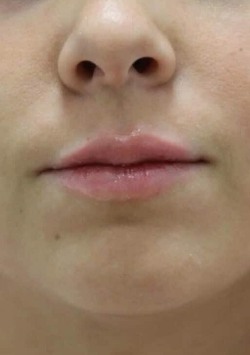 After Image: Lip Filler - front