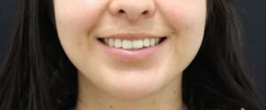 Before Image: Lip Filler + Lip Flip