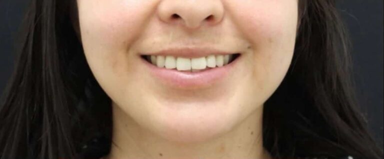 Before Image: Lip Filler + Lip Flip - front