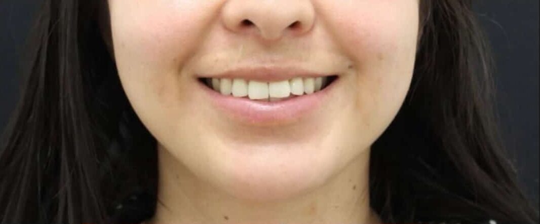 Before Image: Lip Filler + Lip Flip - front