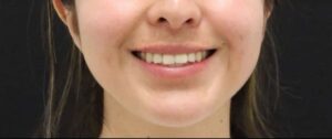 After Image: Lip Filler + Lip Flip